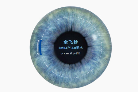 震驚！全飛秒手術(shù)后又近視了？專家教你這樣做